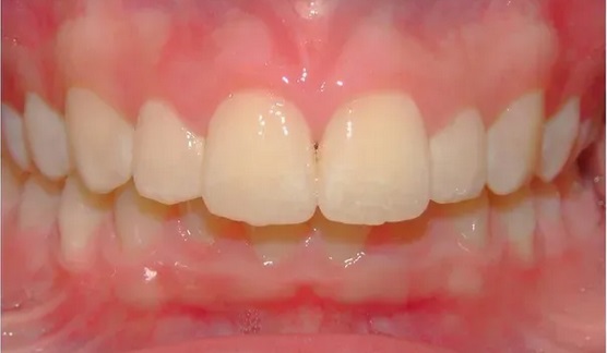 invisalign-before