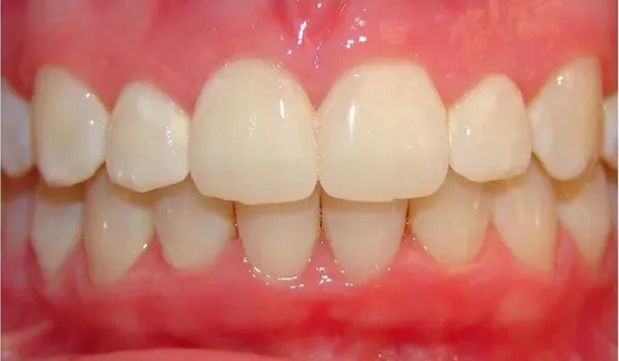 invisalign-after