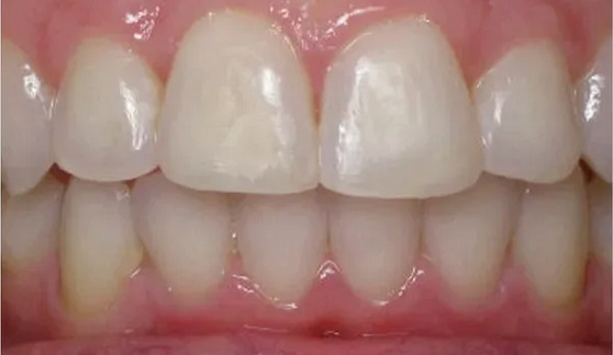 invisalign-after