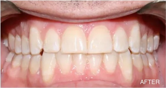 invisalign-after