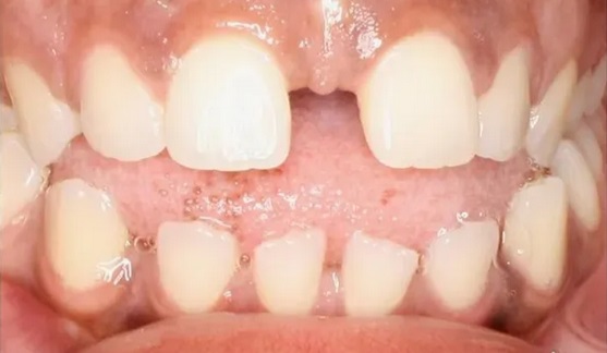 invisalign-before