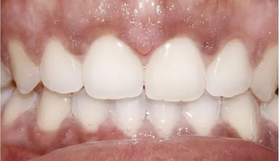 invisalign-after