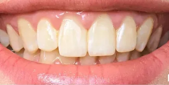 teeth-whitening-before