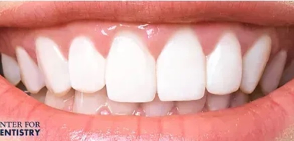 teeth-whitening-after