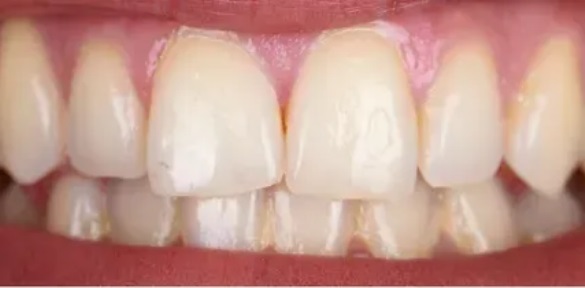 teeth-whitening-before