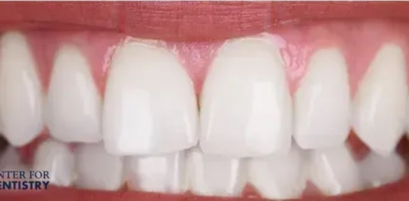 teeth-whitening-after