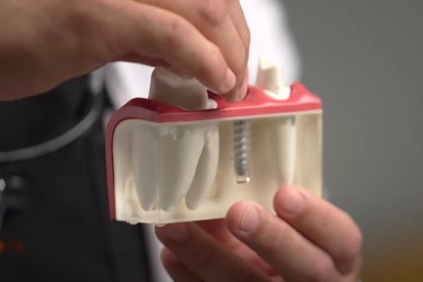 How A Surgical Dental Implant Fuses With  Jawbone