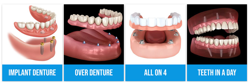 implant denture types