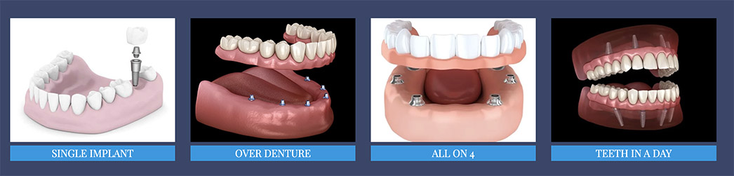 types of implants